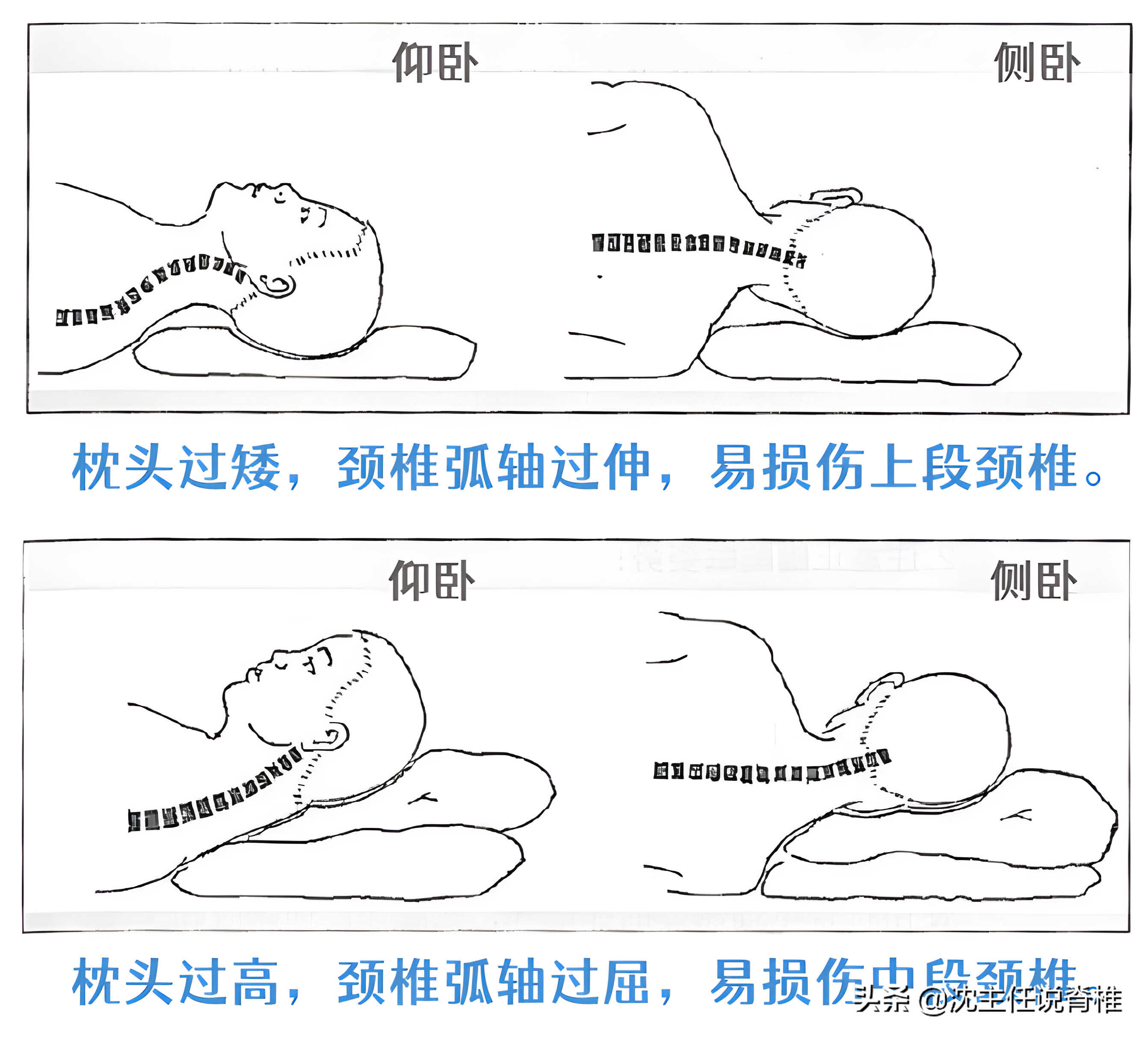 颈椎病人如何选枕头？手把手教您掌握3个关键要点