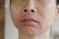 脸上皮肤过敏泛红发痒小妙招（脸上过敏发红处理方法）
